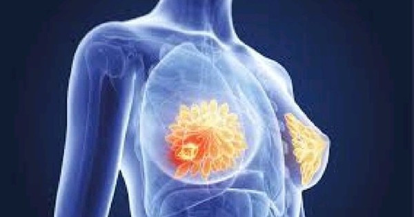 Bệnh viện Ung bướu TPHCM khám tầm soát ung thư vú miễn phí