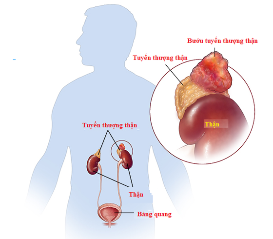 Hình giải phẫu u tuyến thượng thận