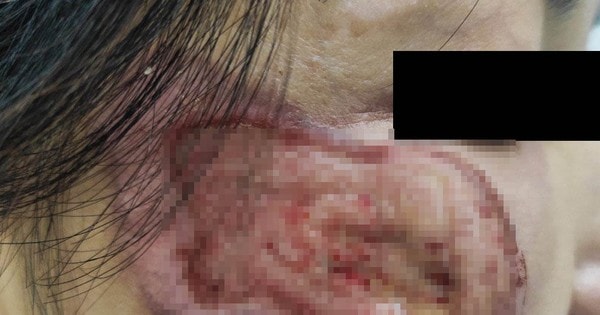 Nhiễm trùng do mua “thuốc chứa axit” để trị nám